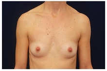 Breast Augmentation Before Photo by Michael Law, MD; Raleigh, NC - Case 33283
