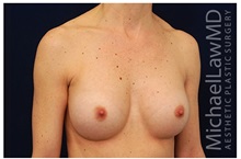 Breast Augmentation After Photo by Michael Law, MD; Raleigh, NC - Case 33283