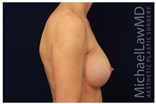 Breast Augmentation After Photo by Michael Law, MD; Raleigh, NC - Case 33283
