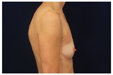 Breast Augmentation Before Photo by Michael Law, MD; Raleigh, NC - Case 33283