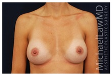 Breast Augmentation After Photo by Michael Law, MD; Raleigh, NC - Case 33285