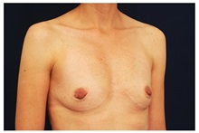 Breast Augmentation Before Photo by Michael Law, MD; Raleigh, NC - Case 33285