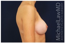 Breast Augmentation After Photo by Michael Law, MD; Raleigh, NC - Case 33285