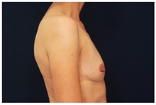 Breast Augmentation Before Photo by Michael Law, MD; Raleigh, NC - Case 33285
