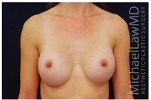 Breast Augmentation After Photo by Michael Law, MD; Raleigh, NC - Case 33287