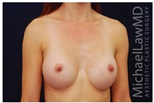 Breast Augmentation After Photo by Michael Law, MD; Raleigh, NC - Case 33287