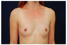 Breast Augmentation Before Photo by Michael Law, MD; Raleigh, NC - Case 33287