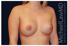 Breast Augmentation After Photo by Michael Law, MD; Raleigh, NC - Case 33298