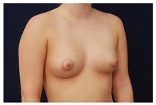 Breast Augmentation Before Photo by Michael Law, MD; Raleigh, NC - Case 33298