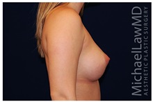 Breast Augmentation After Photo by Michael Law, MD; Raleigh, NC - Case 33298