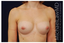 Breast Augmentation After Photo by Michael Law, MD; Raleigh, NC - Case 33301