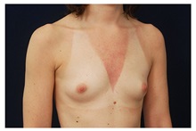 Breast Augmentation Before Photo by Michael Law, MD; Raleigh, NC - Case 33301