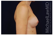 Breast Augmentation After Photo by Michael Law, MD; Raleigh, NC - Case 33301