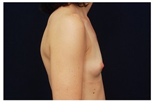 Breast Augmentation Before Photo by Michael Law, MD; Raleigh, NC - Case 33301