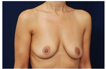 Breast Augmentation Before Photo by Michael Law, MD; Raleigh, NC - Case 33304