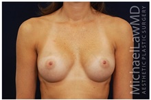 Breast Augmentation After Photo by Michael Law, MD; Raleigh, NC - Case 33306