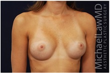 Breast Augmentation After Photo by Michael Law, MD; Raleigh, NC - Case 33306