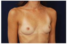 Breast Augmentation Before Photo by Michael Law, MD; Raleigh, NC - Case 33306
