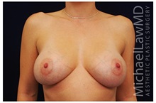 Breast Augmentation After Photo by Michael Law, MD; Raleigh, NC - Case 33309