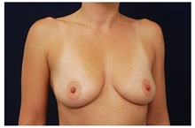 Breast Augmentation Before Photo by Michael Law, MD; Raleigh, NC - Case 33309