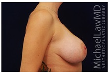 Breast Augmentation After Photo by Michael Law, MD; Raleigh, NC - Case 33309