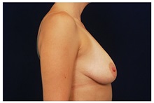 Breast Augmentation Before Photo by Michael Law, MD; Raleigh, NC - Case 33309