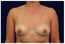 Breast Augmentation Before Photo by Michael Law, MD; Raleigh, NC - Case 33310