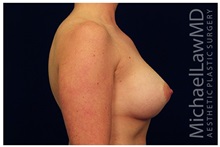 Breast Augmentation After Photo by Michael Law, MD; Raleigh, NC - Case 33310