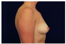 Breast Augmentation Before Photo by Michael Law, MD; Raleigh, NC - Case 33310