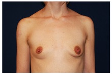 Breast Augmentation Before Photo by Michael Law, MD; Raleigh, NC - Case 33312