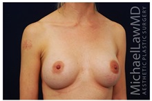 Breast Augmentation After Photo by Michael Law, MD; Raleigh, NC - Case 33312