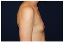Breast Augmentation Before Photo by Michael Law, MD; Raleigh, NC - Case 33312