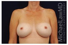 Breast Augmentation After Photo by Michael Law, MD; Raleigh, NC - Case 33313