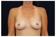 Breast Augmentation Before Photo by Michael Law, MD; Raleigh, NC - Case 33313