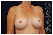 Breast Augmentation After Photo by Michael Law, MD; Raleigh, NC - Case 33313