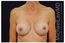 Breast Augmentation After Photo by Michael Law, MD; Raleigh, NC - Case 33314