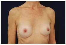 Breast Augmentation Before Photo by Michael Law, MD; Raleigh, NC - Case 33314