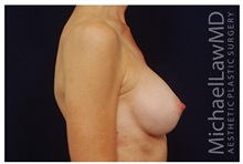 Breast Augmentation After Photo by Michael Law, MD; Raleigh, NC - Case 33314