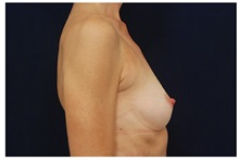 Breast Augmentation Before Photo by Michael Law, MD; Raleigh, NC - Case 33314