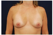 Breast Augmentation Before Photo by Michael Law, MD; Raleigh, NC - Case 33317