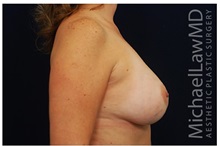 Breast Augmentation After Photo by Michael Law, MD; Raleigh, NC - Case 33317
