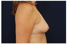 Breast Augmentation Before Photo by Michael Law, MD; Raleigh, NC - Case 33317