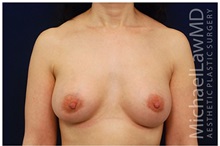 Breast Augmentation After Photo by Michael Law, MD; Raleigh, NC - Case 33492