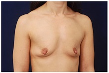 Breast Augmentation Before Photo by Michael Law, MD; Raleigh, NC - Case 33492