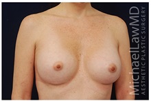 Breast Augmentation After Photo by Michael Law, MD; Raleigh, NC - Case 33493