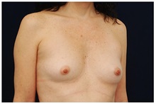 Breast Augmentation Before Photo by Michael Law, MD; Raleigh, NC - Case 33493