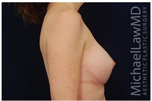 Breast Augmentation After Photo by Michael Law, MD; Raleigh, NC - Case 33493