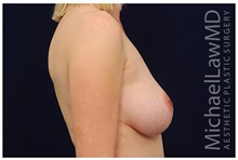 Breast Augmentation After Photo by Michael Law, MD; Raleigh, NC - Case 33495