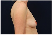 Breast Augmentation Before Photo by Michael Law, MD; Raleigh, NC - Case 33495
