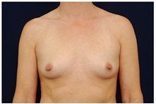 Breast Augmentation Before Photo by Michael Law, MD; Raleigh, NC - Case 33497